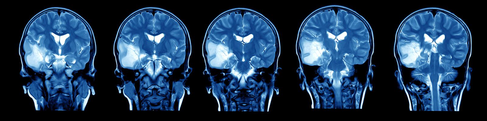 case study of bacterial meningitis